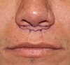 Subnasal-Lip-Lift-Indianapolis-Dr-Barry-Eppley.jpg