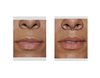 Subnasal-Lip-Lift-immediate-result-front-view.jpg