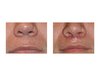 subnasal-lip-lift-in-men-front-view-dr-barry-eppley-indianapolis.jpg