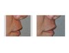 subnasal-lip-lift-in-men-side-view-dr-barry-eppley-indianapolis.jpg