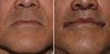 Male-Subnasal-and-Corner-of-Mouth-Lifts-immediate-result-Dr-Barry-Eppley-Indianapolis.jpg