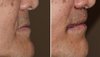 Male-Subnasal-Lip-Lift-and-Corner-of-the-Mouth-Lifts-immediate-result-Dr-Barry-Epley-Indianapo...jpg