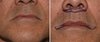 Male-Subnasal-Lip-Lift-and-Corner-of-the-Mouth-Lifts-drawings-Dr-Barry-Eppley-Indianapolis.jpg