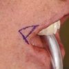 Pennant-Corner-of-the-Mouth-Lift-Dr-Barry-Eppley-Indianapolis-150x150.jpg