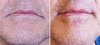 Corner-of-Mouth-Lifts-result-Dr-Barry-Eppleuy-Indianapolis.jpg