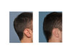 Occipital-Skull-Reduction-result-right-side-view-Dr-Barry-Eppley-Indianapolis.jpg