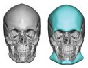 male-custom-forehead-brow-bone-and-jawline-implant-design-front-view-Dr-Barry-Eppley-1024x804.jpg