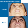 deviated septum before and after.png