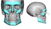 8-Custom-brow-bone-implants-with-other-implants-for-a-facial-masculinizing-1024x587.jpg