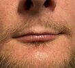 thin-upper-lip-male-Dr-Barry-Eppley-300x273.jpg