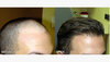 FUE-hair-transplant-before-and-after-1296x728-slide2.jpg