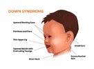 symptoms-of-down-syndrome.jpg