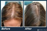 606f8d404030eef4651a7031_Low-Level-Laser-Therapy-Hair-Loss-BA-2.jpeg