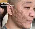 Severe Acne 1.webp Severe Acne 1.webp