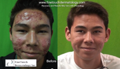 severe acne 2.png severe acne 2.png