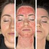 microneedling face.jpg microneedling face.jpg