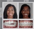 Open Bite Malocclusion Before And After Open Bite Malocclusion Before And After