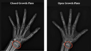 Growth-Plate-difference.png