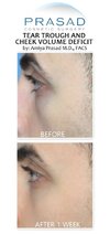tear-trough-and-cheek-volume-filler-left-profile-by-Dr-Amiya-Prasad-1-485x1024.jpg