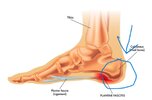 Plantar-facitis.jpg