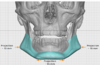 Front Profile Implant Measurements.png