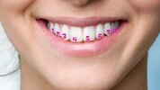 6-or-8-front-teeth-crowns-numbered-on-a-smile-768x433.jpg