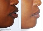 4059676_2387445_Protrusion-dentoalveolaire-bimaxillaire-JuLyDer-avant-et-apres-exp-4-premolaor...jpg