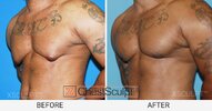 bodybuilder-gynecomastia-before-after-by-XSCULPT-2.jpg
