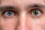 1800x1200_heterochromia_minibead.webp