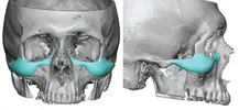 Custom-Infraorbital-Malar-Implants-Dr-Barry-Eppley-Indianapolis-167513156.webp