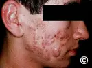 acne_noduloq02_fee391183f15cb4d62773032fe0be92d.webp