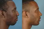 688b5c42efe2a55934466e29_male-chin-filler-1.webp