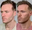 688b5c42efe2a55934466e20_male-cheek-augmentation-6.webp
