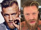 Conor-McGregor-Hair-Transplant-Hairline-Before-After.jpg