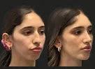 chin-implant-before-and-after-women.webp