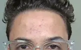 acne.webp