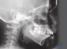 95_D300_Maxillary_Alveolar_Protrusion.webp