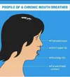 mouth-breather-face.webp