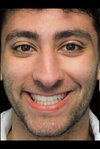 1725990096-bulbous-nose-j*b-everything-you-need-to-know-about-bulbous-nose-tip-surgery-0cdb.jpg