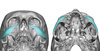 High-Cheekbone-Look-Custom-Infraorbital-Implants-design-Dr-Barry-Eppley-Indianapolis.jpg