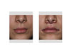 Subnasal-Lip-Lift-and-Mouth-Widening-Procedure-immediate-result-front-view-Dr-Barry-Eppley-Ind...jpg