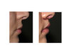 Subnasal-Lip-Lift-and-Mouth-Widening-Procedure-immediate-result-side-view-Dr-Barry-Eppley-Indi...jpg