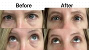 b-a-upper-and-lower-blepharoplasty-with-fat-transfer-v0-z35rv8omofrd1.jpg b-a-upper-and-lower-blepharoplasty-with-fat-transfer-v0-z35rv8omofrd1.jpg