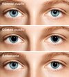 dilated-pupils-330x366-1.jpg