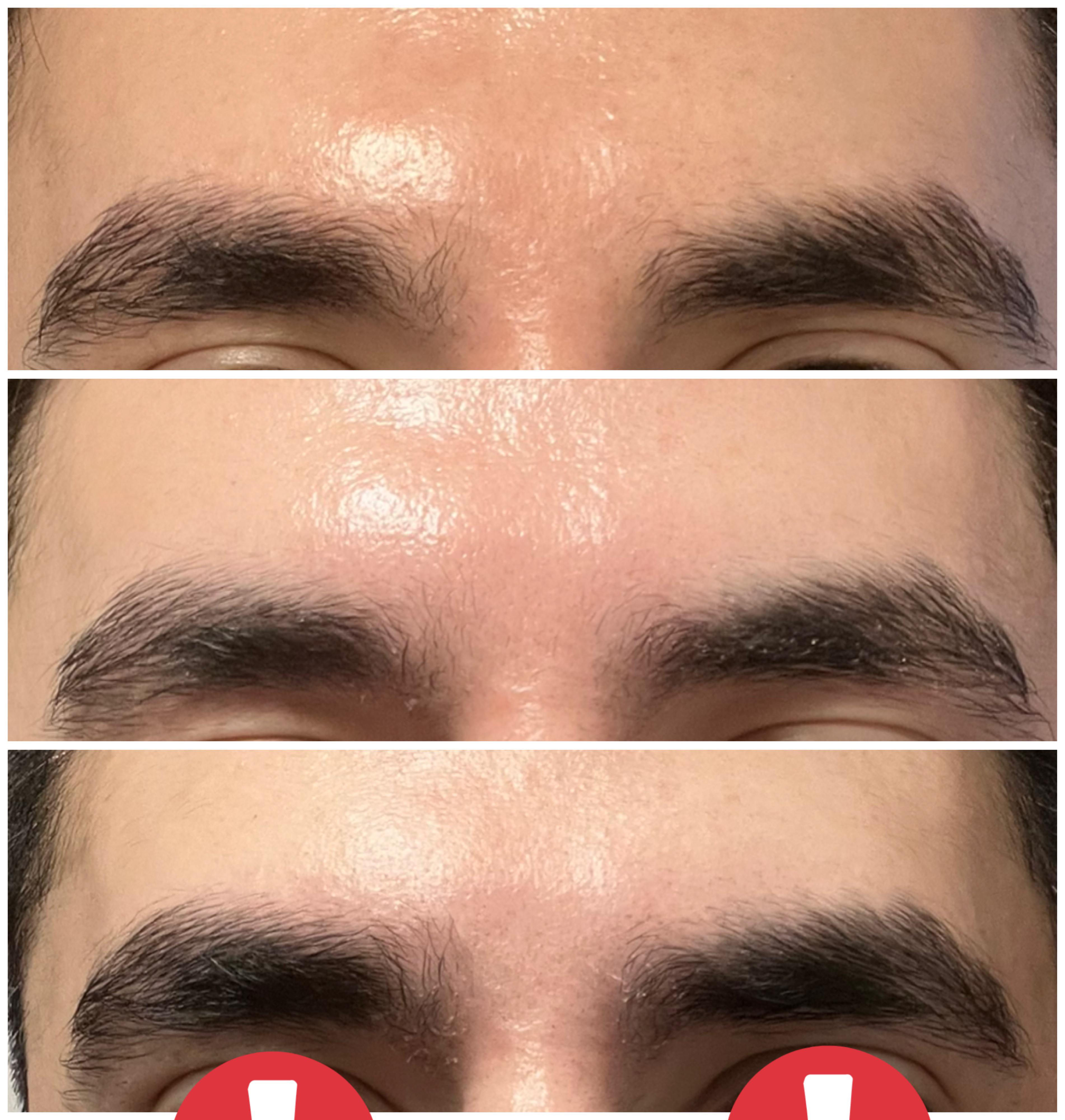 2 month Minoxidil for eyebrows [Before&After] : r/SkincareAddiction
