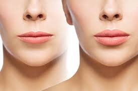 What is Philtrum Reduction?