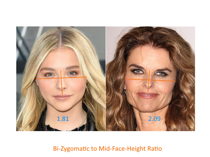 Bi-Zygomatic to Mid-Face-Height Ratio – PinkMirror Blog