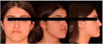 Does Maxillary Retrusion in Skeletal Class III Malocclusion Affect the  Perception of Facial Aesthetics? Evaluation of Different Groups