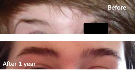 Minoxidil Results After 1 Year - Wimpole Clinic