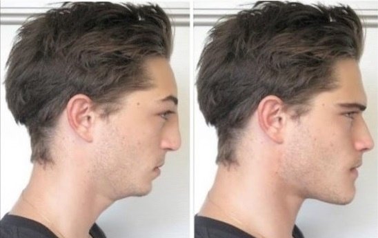 How to find out correctly if your maxilla is recessed or not - Quora